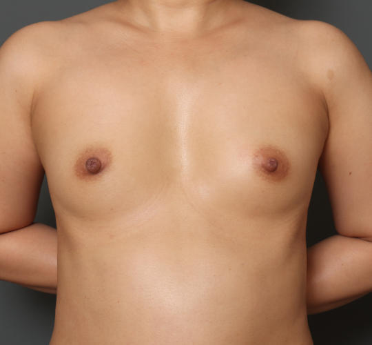 30代女性のピュアグラフト豊胸 Before 症例写真