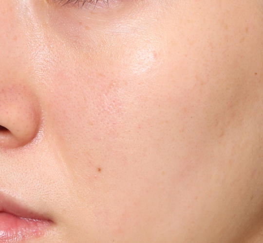 20代女性の肌管理毛穴スリークスキン（ダーマペン4） After 症例写真