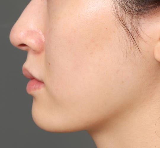 20代女性の肌管理毛穴スリークスキン（ダーマペン4） After 症例写真