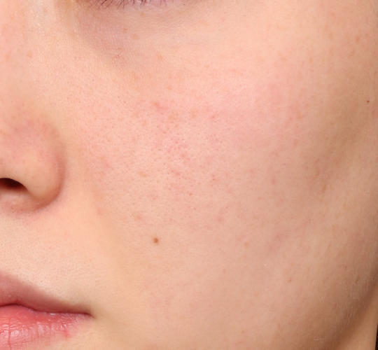 20代女性の肌管理毛穴スリークスキン（ダーマペン4） Before 症例写真