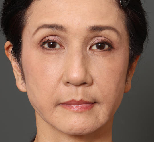 60代女性のチークリフト・フェイスリフト Before 症例写真