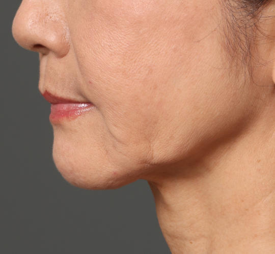 60代女性のチークリフト・フェイスリフト Before 症例写真