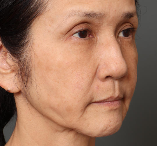 60代女性のチークリフト・フェイスリフト Before 症例写真