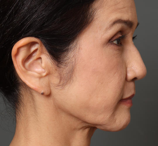 60代女性のチークリフト・フェイスリフト Before 症例写真