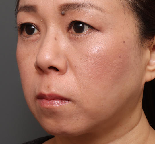 40代女性の下まぶたのたるみ取り After 症例写真