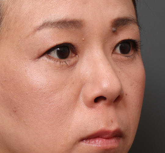 40代女性の下まぶたのたるみ取り After 症例写真