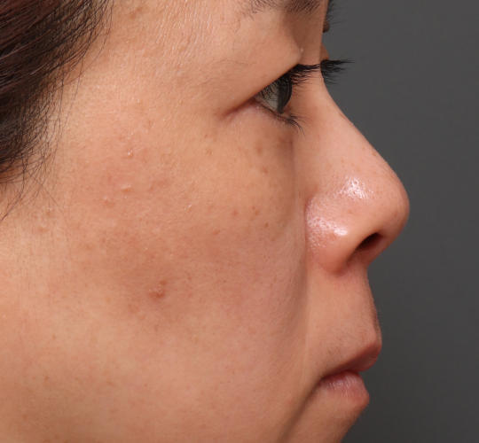 40代女性の下まぶたのたるみ取り After 症例写真