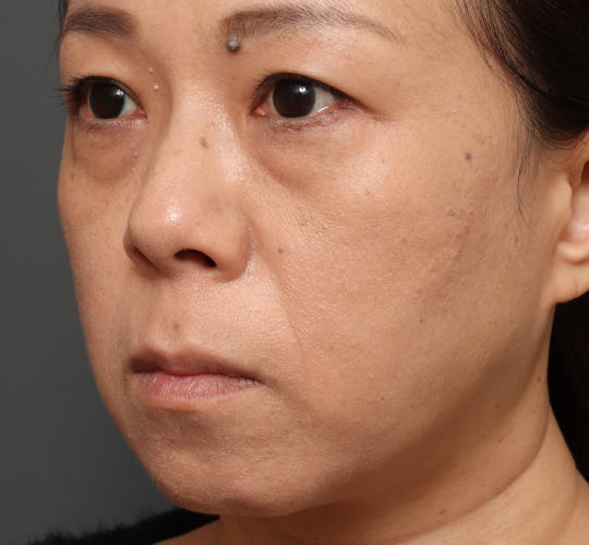 40代女性の下まぶたのたるみ取り Before 症例写真