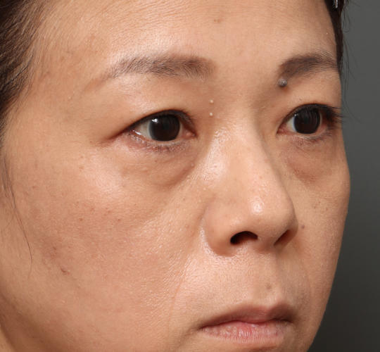 40代女性の下まぶたのたるみ取り Before 症例写真
