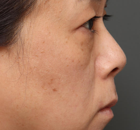 40代女性の下まぶたのたるみ取り Before 症例写真