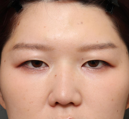 20代女性の二重整形・目元の整形 Before 症例写真