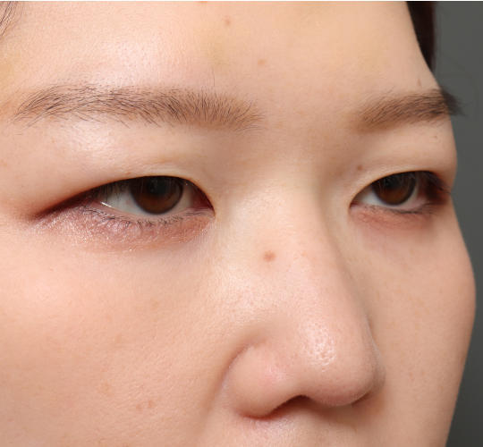 20代女性の眉下切開法 Before 症例写真