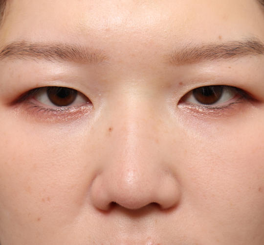 20代女性の眉下切開法 Before 症例写真