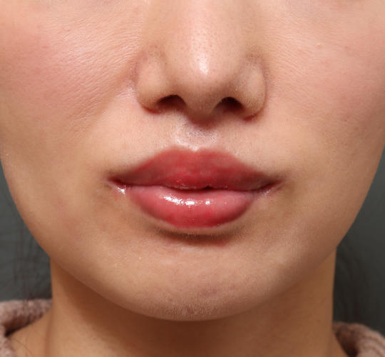 30代女性の人中短縮（リップリフト） After 症例写真