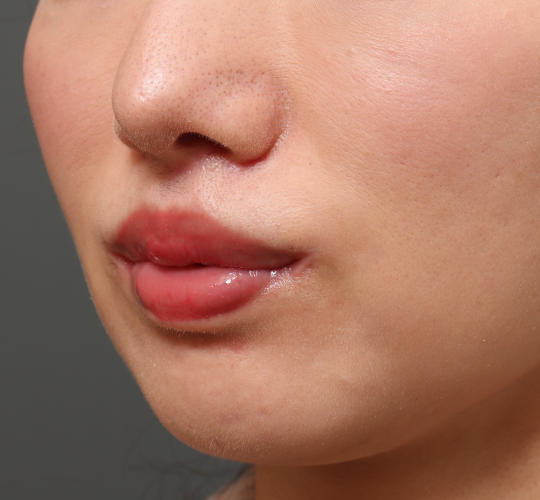 30代女性の人中短縮（リップリフト） After 症例写真