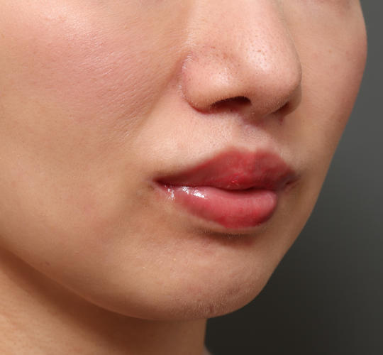30代女性の人中短縮（リップリフト） After 症例写真