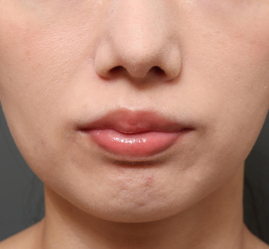 30代女性の人中短縮（リップリフト） Before 症例写真