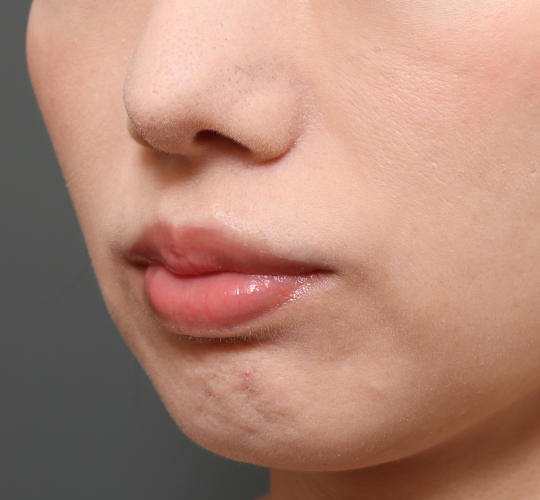 30代女性の人中短縮（リップリフト） Before 症例写真