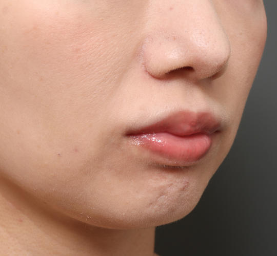 30代女性の人中短縮（リップリフト） Before 症例写真