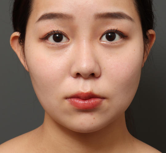 20代女性の顔の脂肪吸引  After 症例写真