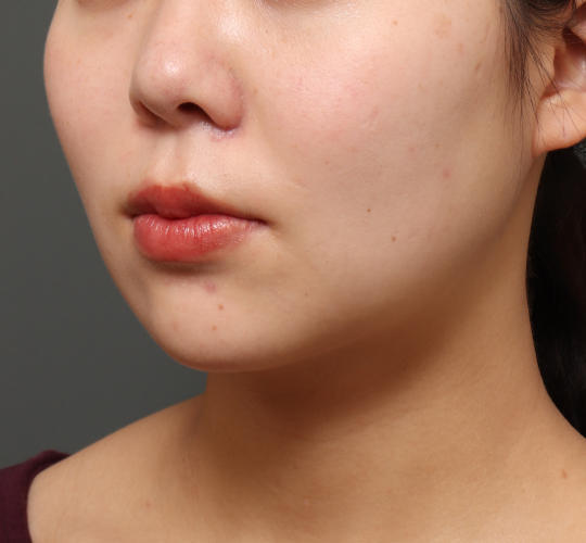 20代女性の顔の脂肪吸引 After 症例写真