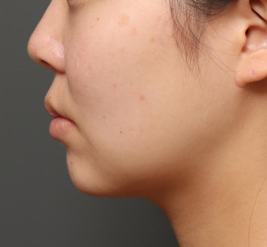 20代女性の顔の脂肪吸引  After 症例写真