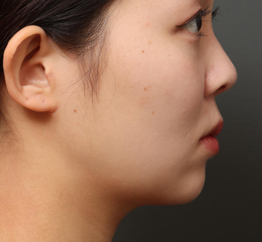 20代女性の顔の脂肪吸引  After 症例写真