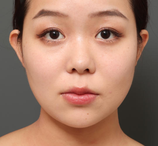 20代女性の顔の脂肪吸引  Before 症例写真