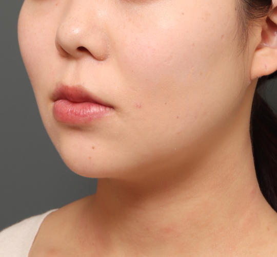 20代女性の顔の脂肪吸引 Before 症例写真