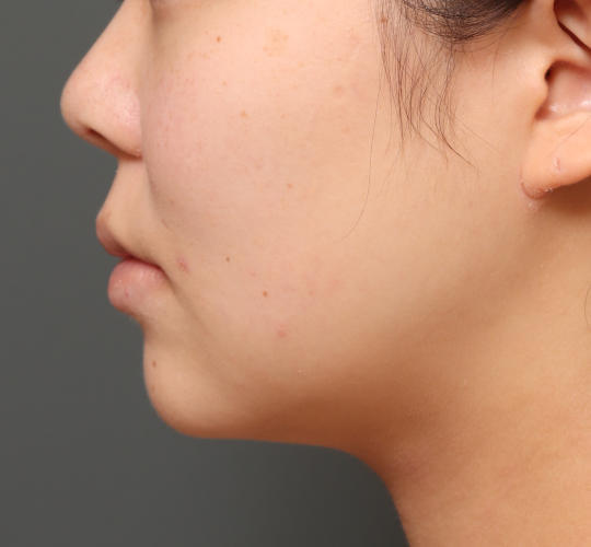 20代女性の顔の脂肪吸引  Before 症例写真