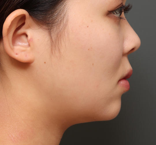 20代女性の顔の脂肪吸引  Before 症例写真