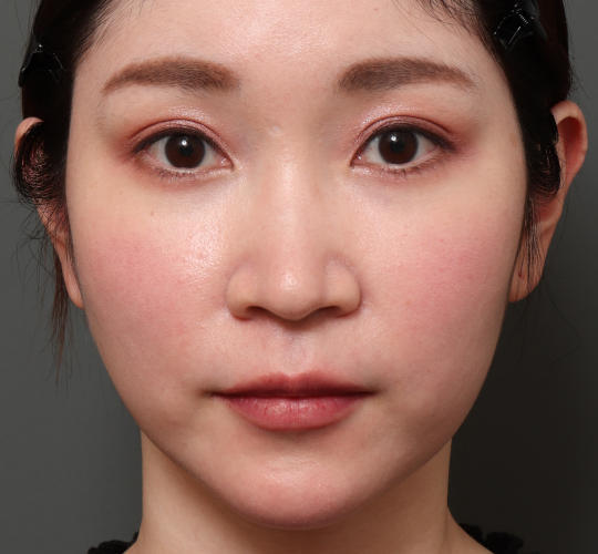 20代女性の人中短縮（リップリフト） Before 症例写真