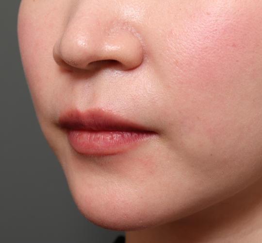 20代女性のM字リップ形成 Before 症例写真