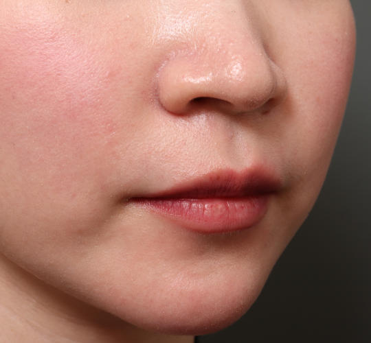 20代女性のM字リップ形成 Before 症例写真