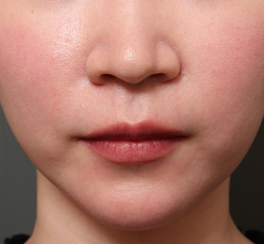 20代女性のM字リップ形成 Before 症例写真