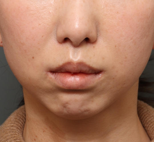 30代女性の人中短縮（リップリフト） After 症例写真