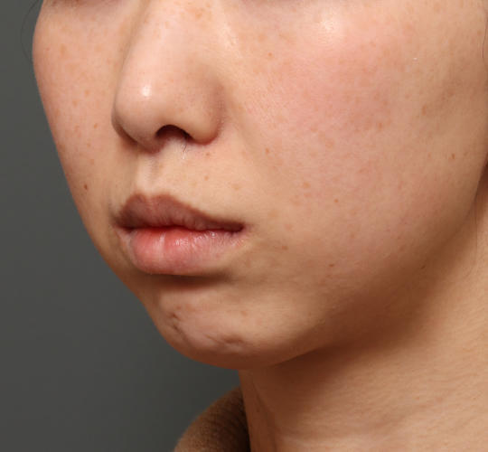 30代女性の人中短縮（リップリフト） After 症例写真
