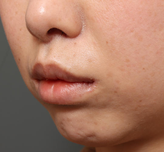 30代女性の人中短縮（リップリフト） After 症例写真