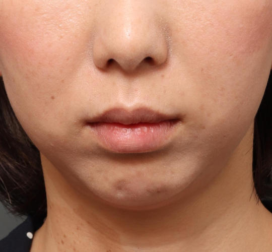 30代女性の人中短縮（リップリフト） Before 症例写真