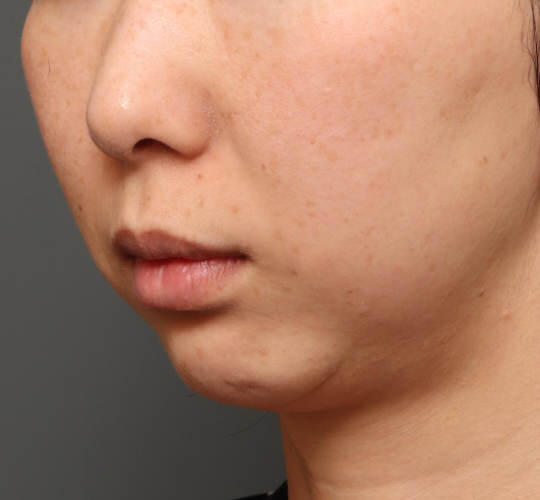 30代女性の人中短縮（リップリフト） Before 症例写真