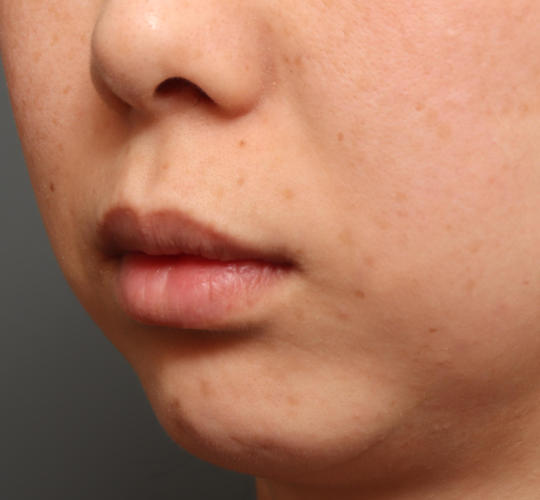 30代女性の人中短縮（リップリフト） Before 症例写真