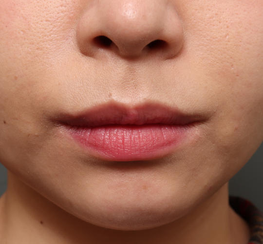 20代女性の口角挙上（スマイルリップ） After 症例写真