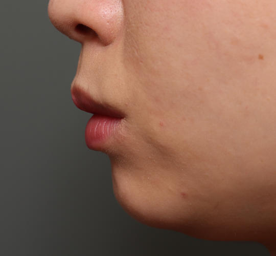 20代女性の口角挙上（スマイルリップ） After 症例写真