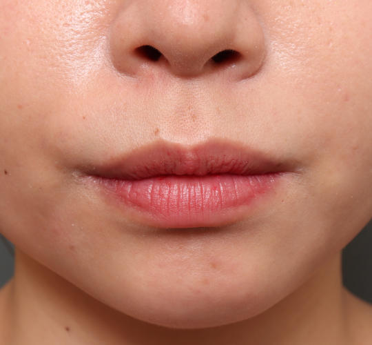 20代女性の口角挙上（スマイルリップ） Before 症例写真
