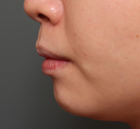 20代女性の口角挙上（スマイルリップ） Before 症例写真