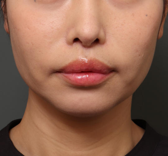 40代女性の人中短縮（リップリフト） After 症例写真