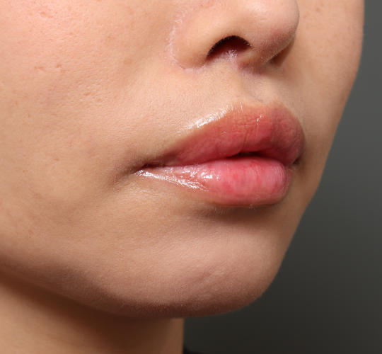 40代女性の人中短縮（リップリフト） After 症例写真