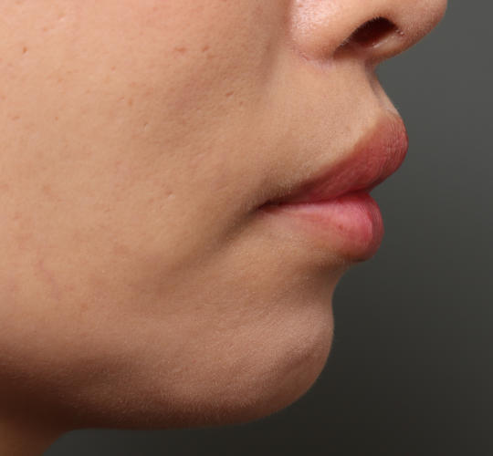 40代女性の人中短縮（リップリフト） After 症例写真