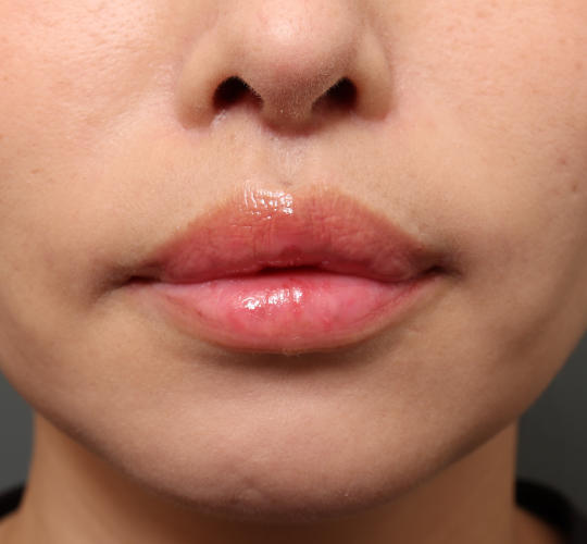 40代女性の人中短縮（リップリフト） After 症例写真
