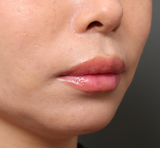 40代女性の人中短縮（リップリフト） Before 症例写真